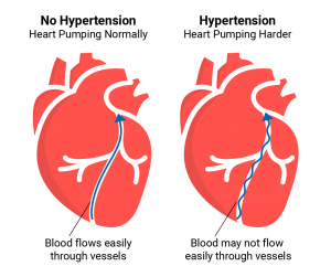 فشار خون در بیماران قلبی و عروقی
